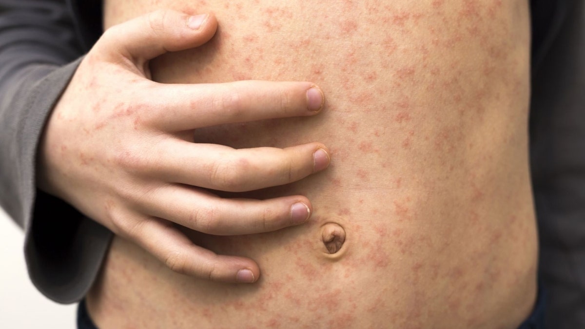 Seattle health officials warn of measles case at Seattle International Airport