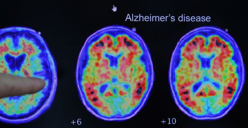 © Reuters. FILE PHOTO: Evidence of Alzheimer’s disease on PET scans. March 30, 2023. REUTERS/Brian Snyder/File Photo Cassava Sciences must face malicious prosecution lawsuit over Alzheimer’s drug